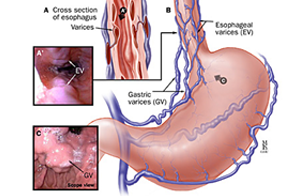 Band Ligation