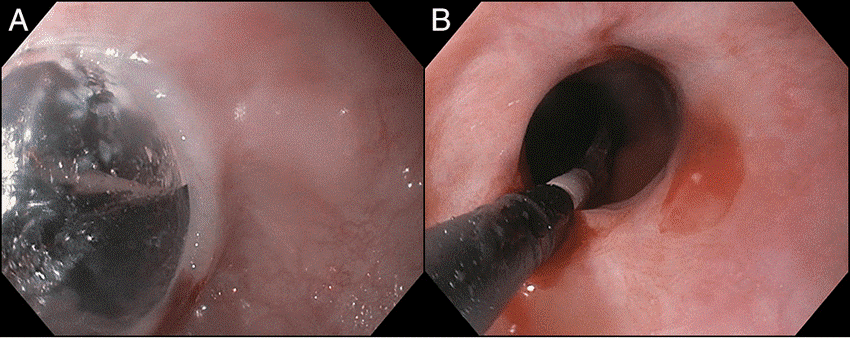 Endoscopy Dilation