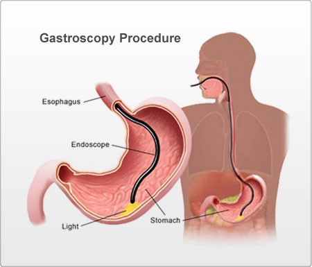 Upper GI Endoscopy