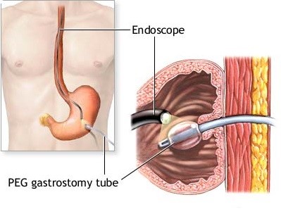 Percutaneous EG