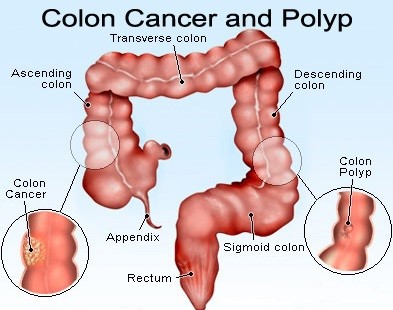 Polyps Removal