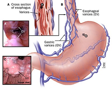 Variceal Banding